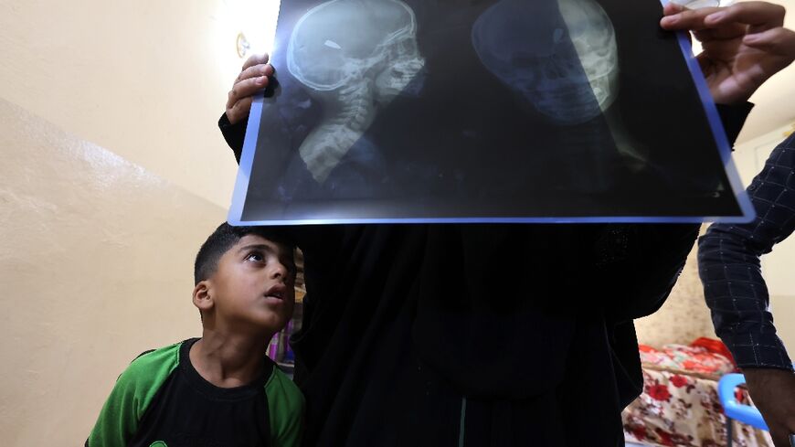 Four-year-old Mohamed looks at the X-ray showing the bullet lodged in his head