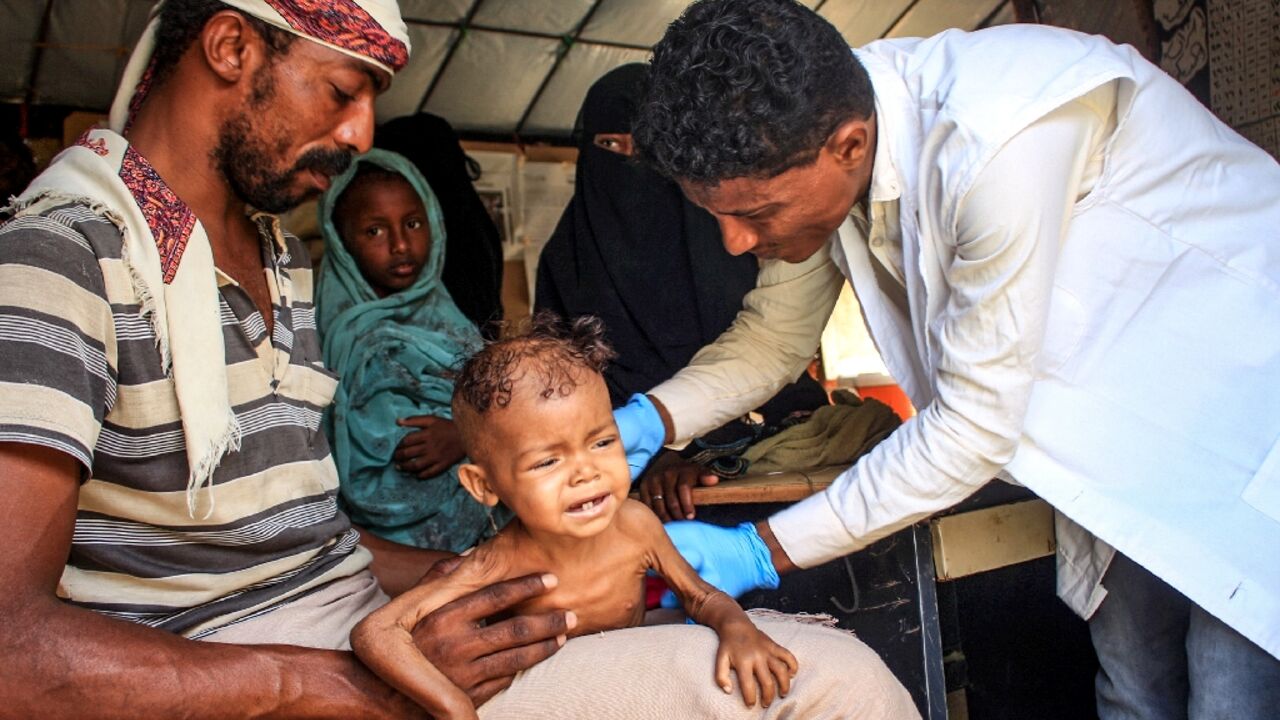 Three-year-old Yemeni child Randa Ali, suffering from severe acute malnutrition, is carried by her father in the Abs district of Yemen's northwest on February 19