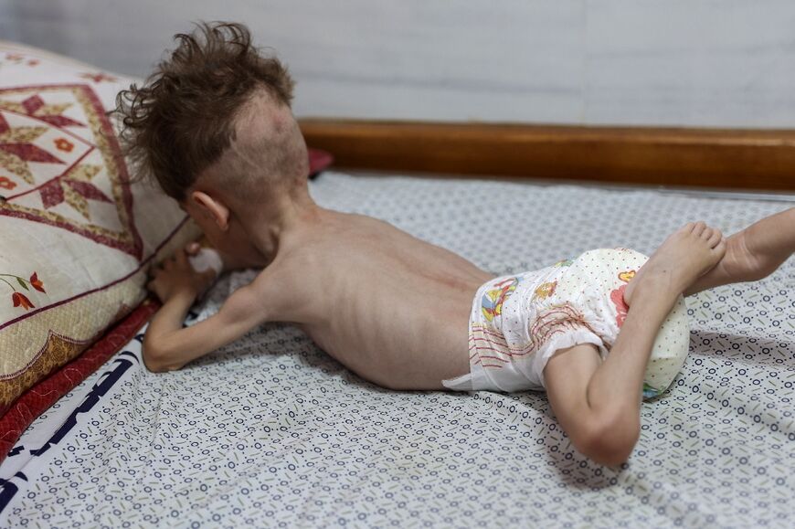 Palestinian toddler Uday Mahra, suffering from malnutrition, at Kamal Adwan hospital in northern Gaza